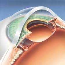 Intraocular Lens (IOL) Market – Global Industry Analysis and Forecast (2017-2026)