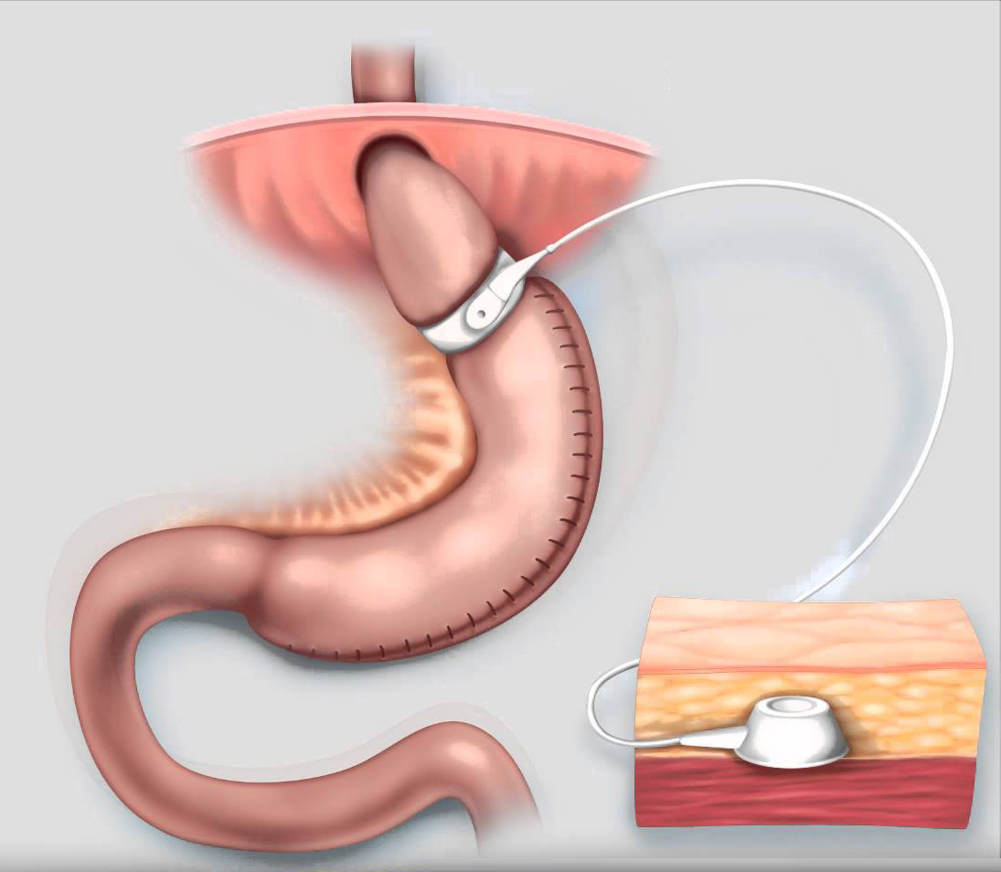 Adjustable Gastric Banding Market In-deep Analysis And Experts Review Report 2019-2025