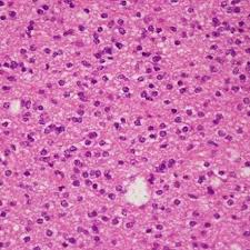 Anaplastic Oligoastrocytoma Market 2019 Analysis and Precise Outlook – Insys Therapeutics, Rush University Medical Center