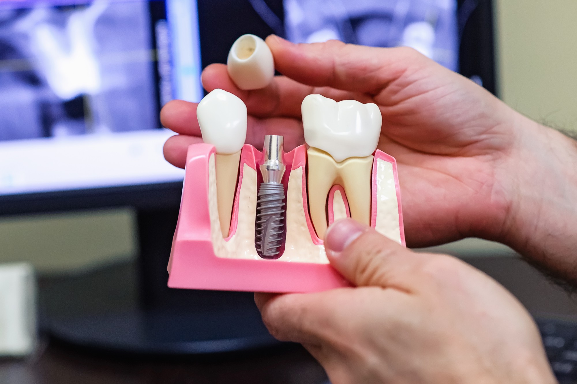 Dental Implant Market Global Research Report by Experts 2019 to 2024