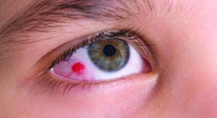 Global Eye Melanoma Drug Market Quantitative Study 2019 By Amgen Inc, AstraZeneca, Bristol-Myers Squibb Company, Bayer AG, Johnson & Johnson Services,Carl Zeiss AG, Optovue, Incorporated, Siemens & Others