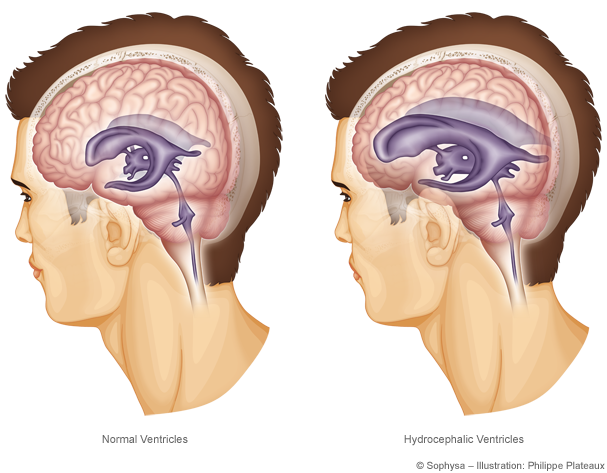 Hydrocephalus Shunts Market In-deep Analysis And Experts Review Report 2019-2024