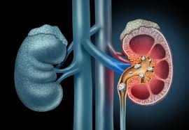 Kidney Stones Management Market