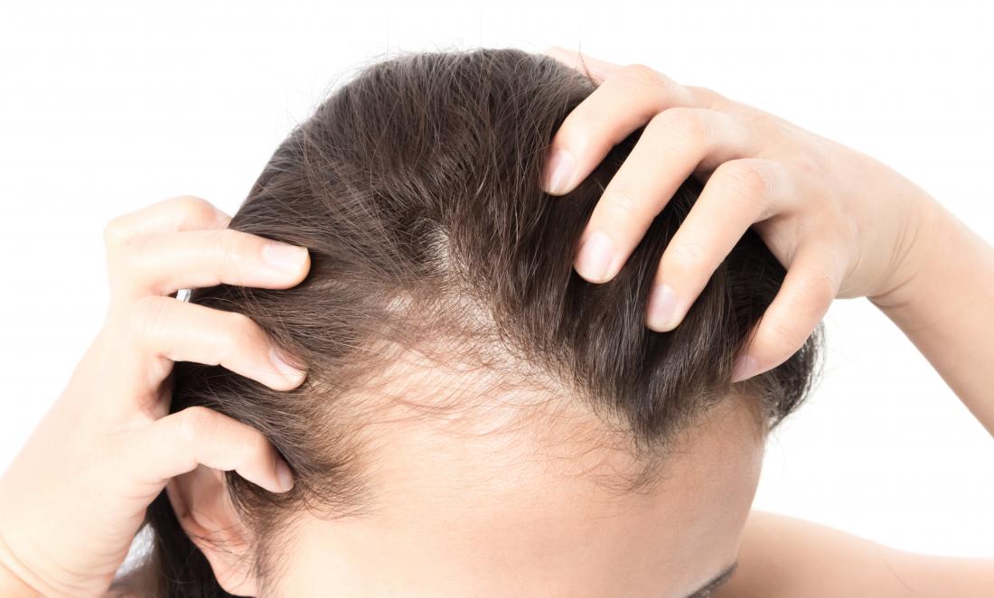 Management Of Hair Loss Market 