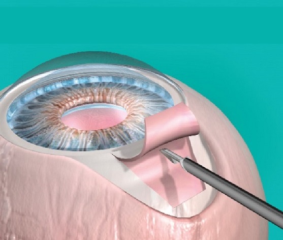 Micro-Invasive Glaucoma Implants Market Research,	 Industry Size With Alcon, Bausch & Lomb, Carl Zeiss, Johnson & Johnson Vision Care, Lumenis, Glaukos, Ellex Medical Lasers, IRIDEX