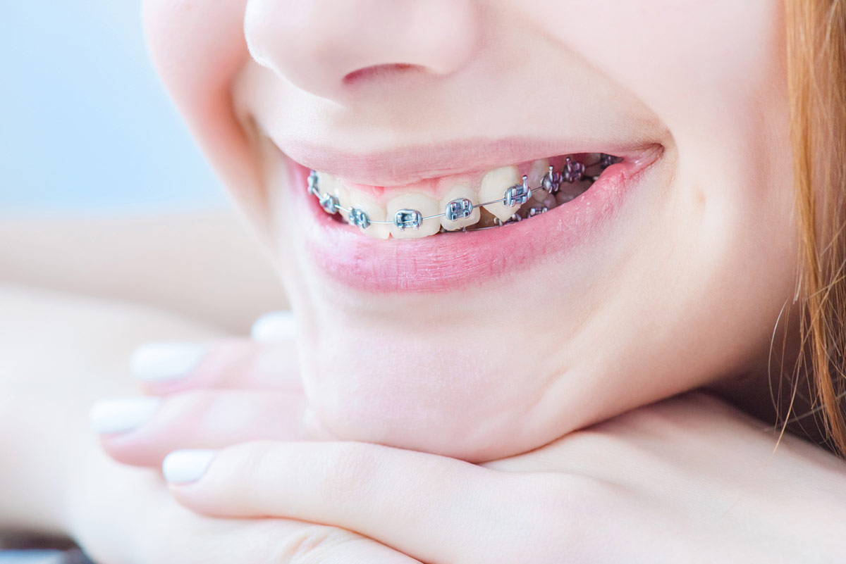 Orthodontic Supplies Market Expert Reviews & Analysis 2019 Along With Study Reports