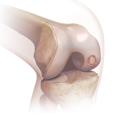 Osteochondral Implants