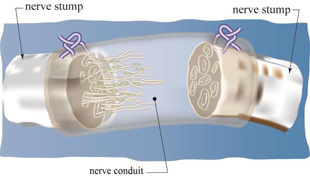Peripheral Nerve Repair Market Expert Reviews & Analysis 2019 Along With Study Reports