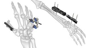 Small Bone Fixation Systems