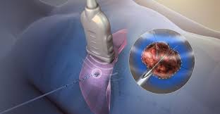 Tumor Ablation Market – Global industry analysis and forecast (2018-2026)