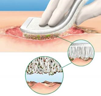 Wound Debridement Devices Market To 2025 End to End Solutions with Top Most Industry Players as B. Braun Melsungen AG., BioMonde, BSN medical, Coloplast Group, DeRoyal Industries, Hollister Incorporated & Others