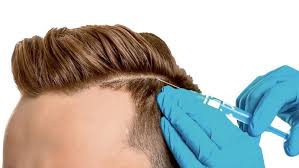 Global Hair Transplant Market – Industry Analysis and Forecast (2019-2026)