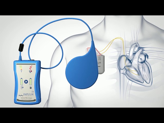 Global Implantable Pulse Generators Market Witnessing Enormous Growth By Cyberonics, Inc.; Boston Scientific Corporation; Dextronix,CorMedix,NeuroPace,ReShape Lifesciences,Stimwave & Others