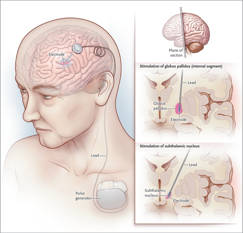 Global Deep Brain Stimulation Market Outlook On Key Growth Trends and Forecast Until 2025|Functional Neuromodulation Ltd., MicroTransponder Inc., Aleva Neurotherapeutics SA.