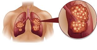 Global Lung Cancer Diagnostic Tests Market Revenue Strategy 2020 – Advpharma Inc, AIT Austrian Institute of Technology GmbH