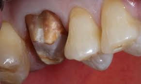 Global Resin Dental Cements Market Strategic Insights 2020 – 3M, KaVo Kerr, Kuraray, Sun Medical, BISCO