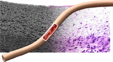 Global Small-Sized Vascular Graft Market Strategic Insights 2020 – W. L. Gore, Getinge, Bard PV, Terumo