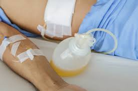 Global Surgical Drainage Bags Market Key Business Opportunities | Adams Plastics, Medline, Coloplast Corp, Cardinal Health