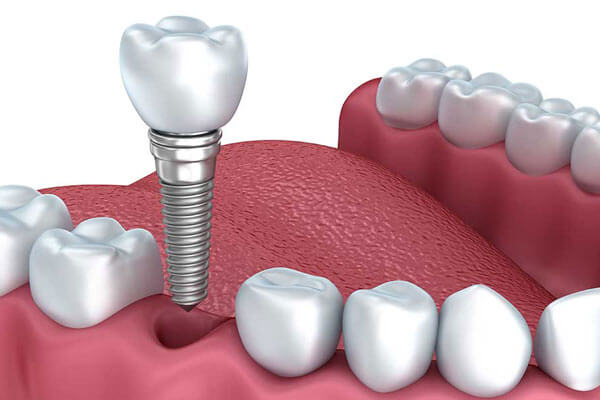 Global Titanium Dental Material Market Key Business Opportunities | Wieland Dental + Technik, Amann Girrbach, Zirkonzahn, Trinon, Kavo