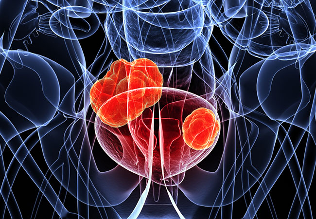 Global Bladder Cancer Market Comprehensive Growth by 2020 to 2024 : Bristol-Myers Squibb, Eli Lilly, F. Hoffman-La Roche, Pfizer