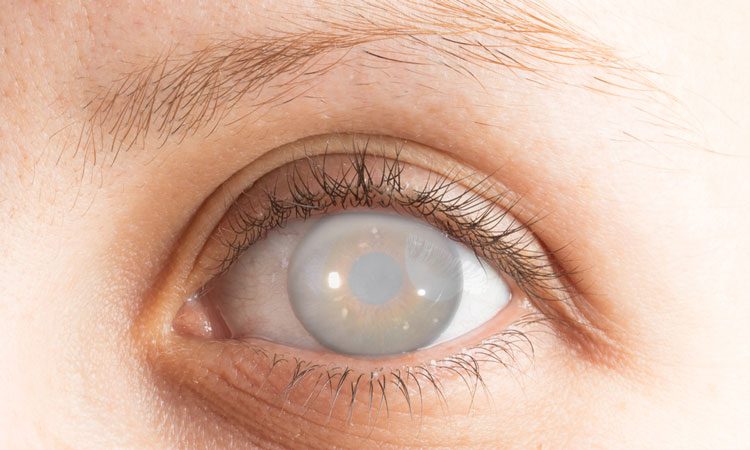 Global Corneal Graft Rejection Drug Market Trends By 2026|Circadian Technologies Limited, Gene Signal International SA, Oxford BioMedica Plc