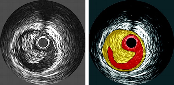 Global Coronary Intravascular Ultrasound Market 2020, Industry Insights, Trends and Forecast by 2024 : Volcano, Boston Scientific, Terumo