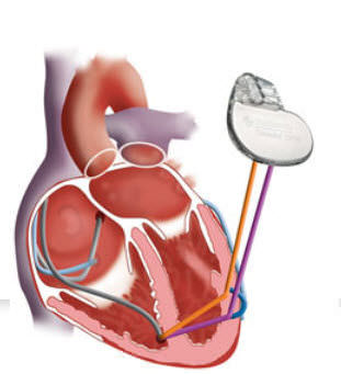 Crt Pacemaker Crt P Market (2020-2027) | Growth Analysis By Boston Scientific, Medtronic, St. Jude Medical, Biotronik