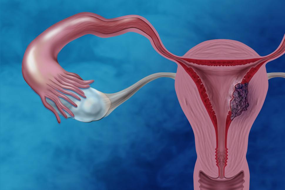 Endometrial Cancer Market (2020-2027) | Growth Analysis By Pfizer, Johnson & Johnson, Boston Scientific, GE