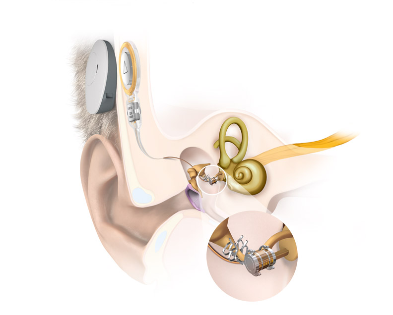 Global Middle Ear Implants Market Analysis by SWOT, Investment, Future Growth and Major Key Players 2024 | Phonak, Starkey, Cochlear, Oticon, Sivantos