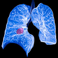 Global Small Cell Lung Cancer Treatment Market Comprehensive Growth by 2020 to 2024 : Teva, Bristol myers, Novartis, Elekta, Siemens