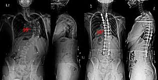 Global Spinal Fusion Market Segmentation, Application, Technology & Market Analysis Research Report 2026 | Stryker Corporation, Medtronic