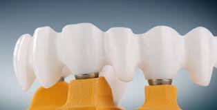 Global Zirconia Dental Material Market Evolving Trends with Changing Dynamics and Growth Opportunities 2020 – 2026 | Dentsply Sirona, Sagemax Bioceramics