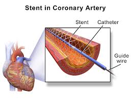 COVID-19 Epidemic Impact On Cardiology Stents Market –  Industry Inflation till 2030