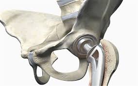 Global Bone Saddle Market 2020: Eastman, Panasonic(Sanyo), Samsung SDI, LG Chem, Sony