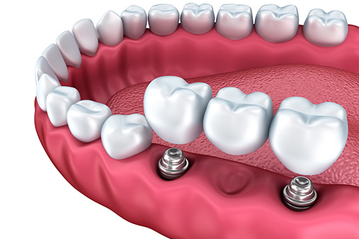 Dental Implant and Prosthetic Market is Ready to Set Outstanding Growth in 2020 | Institut Straumann, Danaher, Dentsply Sirona, Zimmer Biomet Holding
