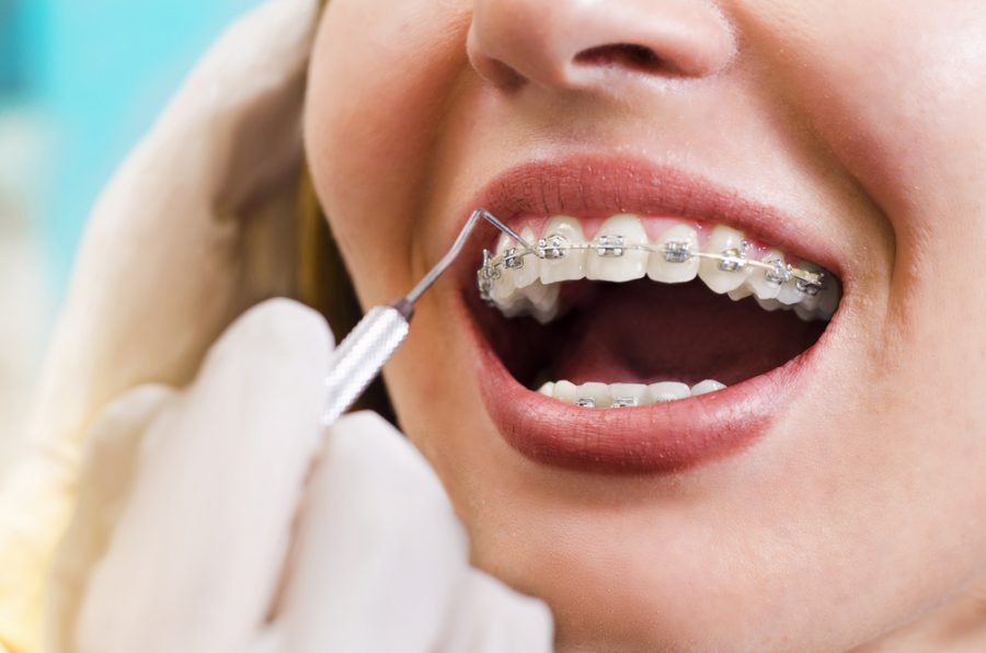 Having Questions On How Braces Work? Read To Know More
