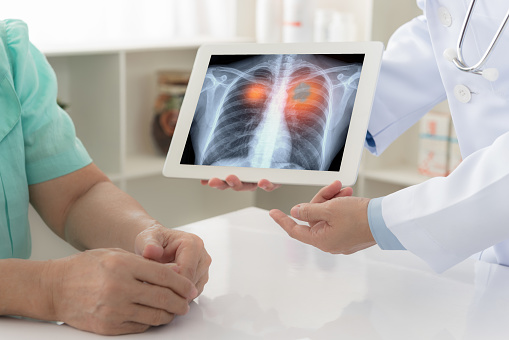 Lung Cancer Surgery Market Incredible Potential, Stagnant Progress According to New Research Report