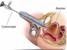 Global Cystoscope Market 2020- Karl Storz, Olympus, Stryker, Richard Wolf, HOYA