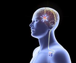 Global Deep Brain Stimulation Devices Market 2020- Boston Scientific, Medtronic, St Jude Medical, Beijing Pins, SceneRay