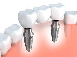 Global Dental Fitting Market 2020- Danaher, Densply, Modern Dental, Ivoclar Vivadent, 3M