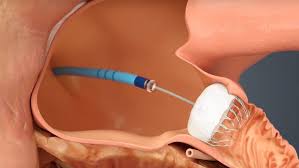 Global Stents and Related Implants Market 2020:  Stryker Corporation, Synthes, Boston Scientific, Zimmer Biomet